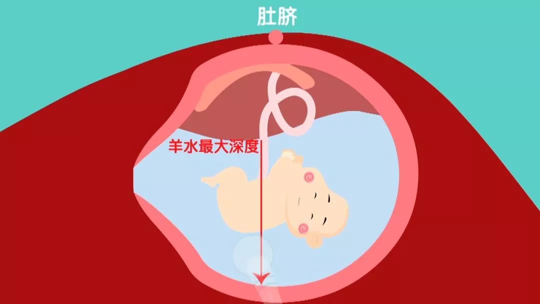 羊水异常_羊水报告异常_羊水穿刺有异常
