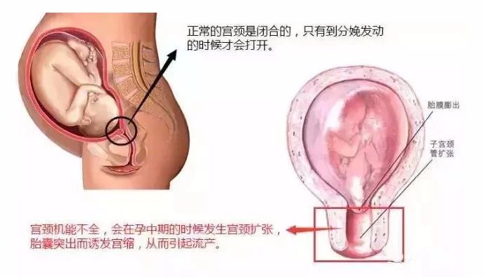 子宫扩张器有什么用宫颈机能不全导致多次流产，腹腔镜下宫颈环扎术为您保驾护航_https://www.jmylbn.com_新闻资讯_第3张